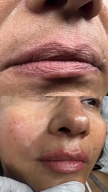 Lips filler (before & after)